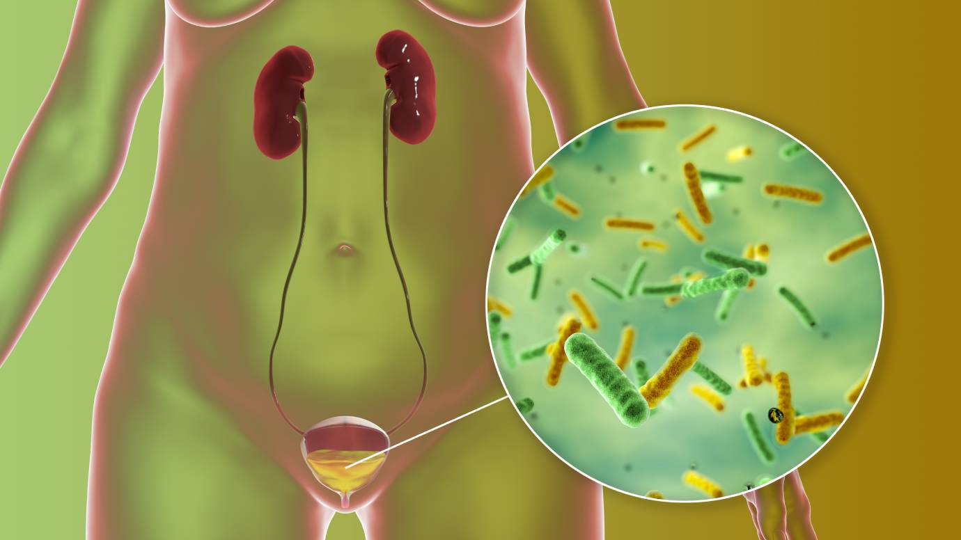 CHRONIC URINARY TRACT INFECTION – EVERYTHING YOU NEED TO KNOW ABOUT IT
