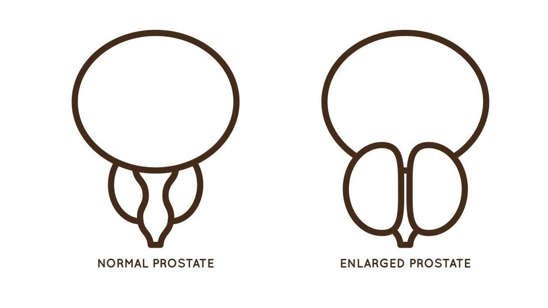 Does an Enlarged Prostate Affect a Man Sexually?