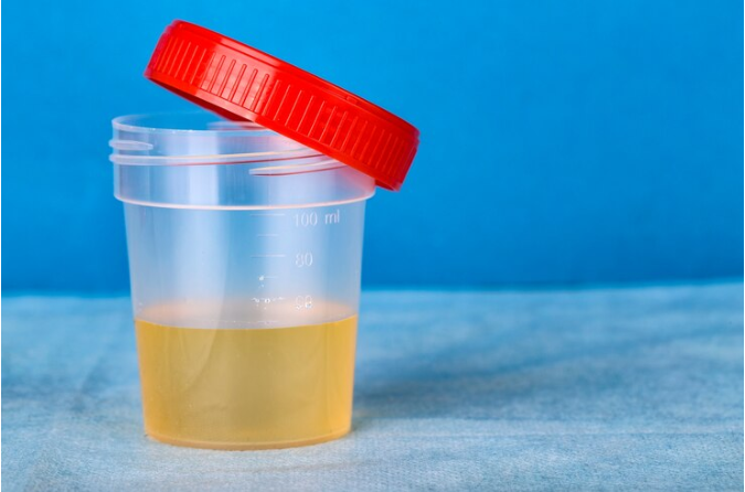 Uric Acid Crystals in Urine