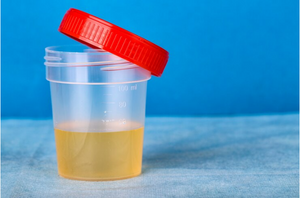 Symptoms of Uric Acid Crystals in Urine and How to Treat Them