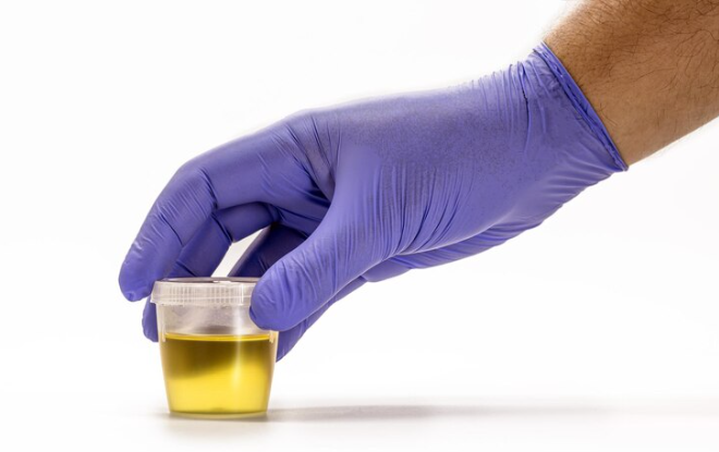 Yellow Urine: Understanding Causes & Solutions