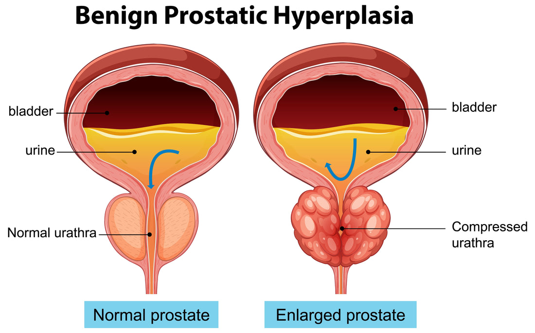 Prostate Size: What’s Considered Normal and When to Be Concerned