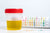 5 Hidden Causes of Turbid Urine That You Probably Didn't Know